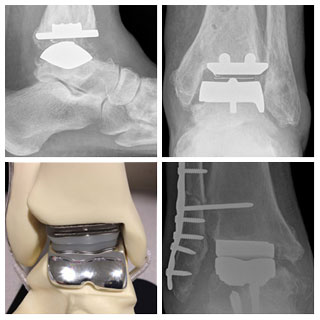 Ankle Replacement