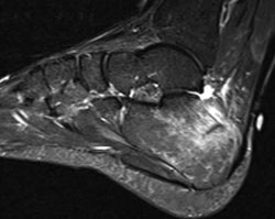 Calcaneus stress fracture