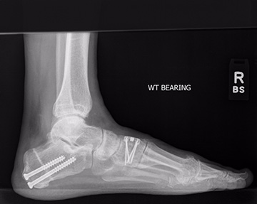 Posterior tibial tendon reconstruction